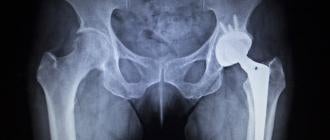Stryker Hip Implant Settlement
