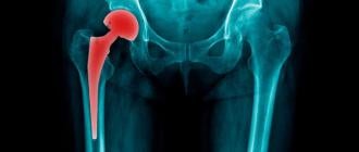 Stryker Hip Implants Lawsuit