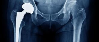 Stryker Hip Implants