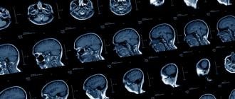 Neurovascular Stents Lawsuit