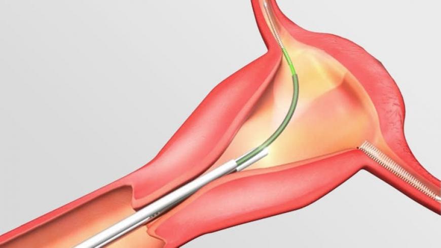 fda essure study failure