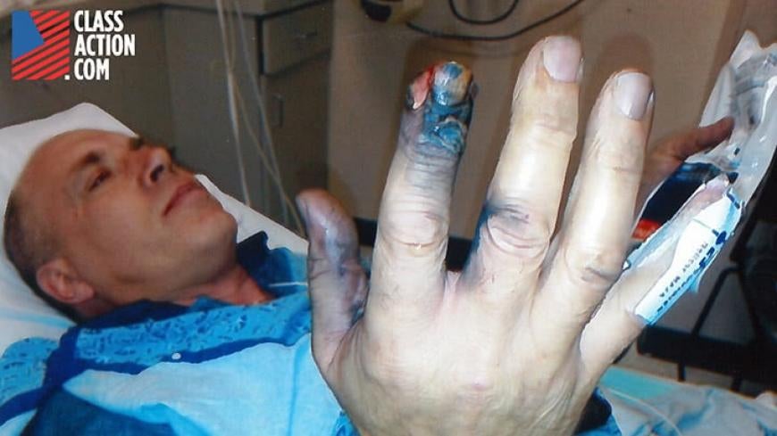 Dardini injured finger from phone explosion