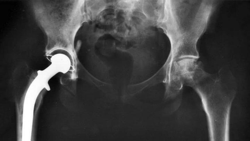 Stryker Hip Implant right leg defective