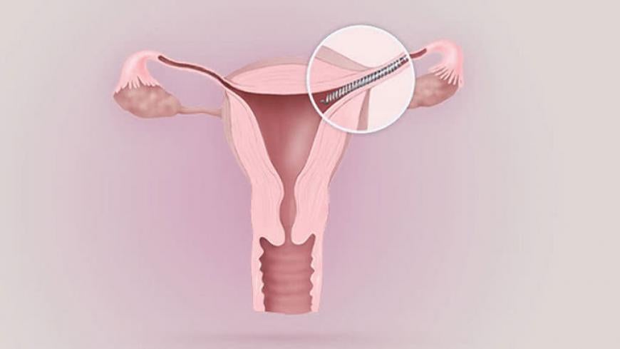 Essure Birth Control warnings of defects
