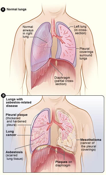 peritoneal mesothelioma pathogenesis