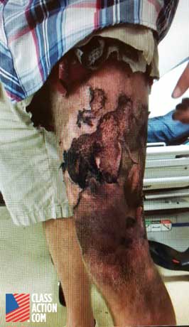 David Studer's leg after an e-cig battery allegedly exploded in his pocket.