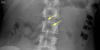 Radiograph_showing_IVC_Filter_Fracture